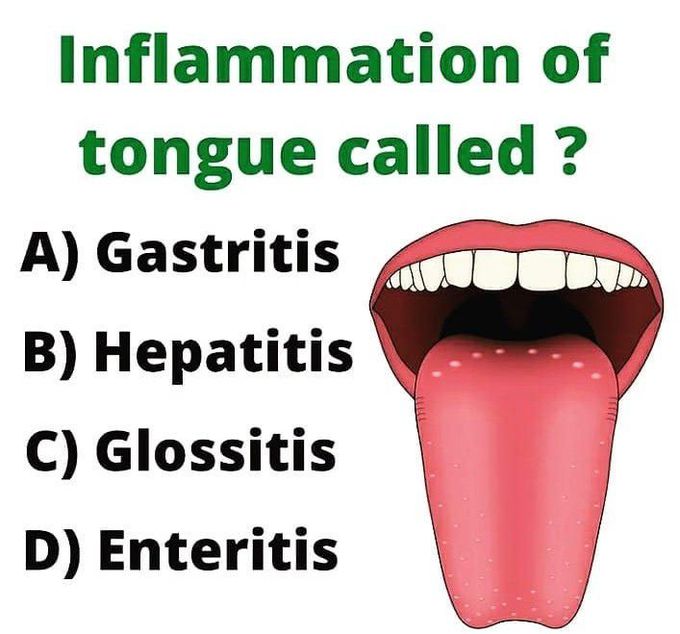 Inflammation of tongue is called.......?
