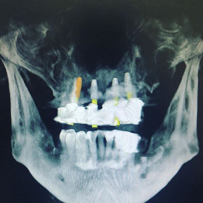 Planning four implants on the maxilla for an implant retained overdenture 👅👄 