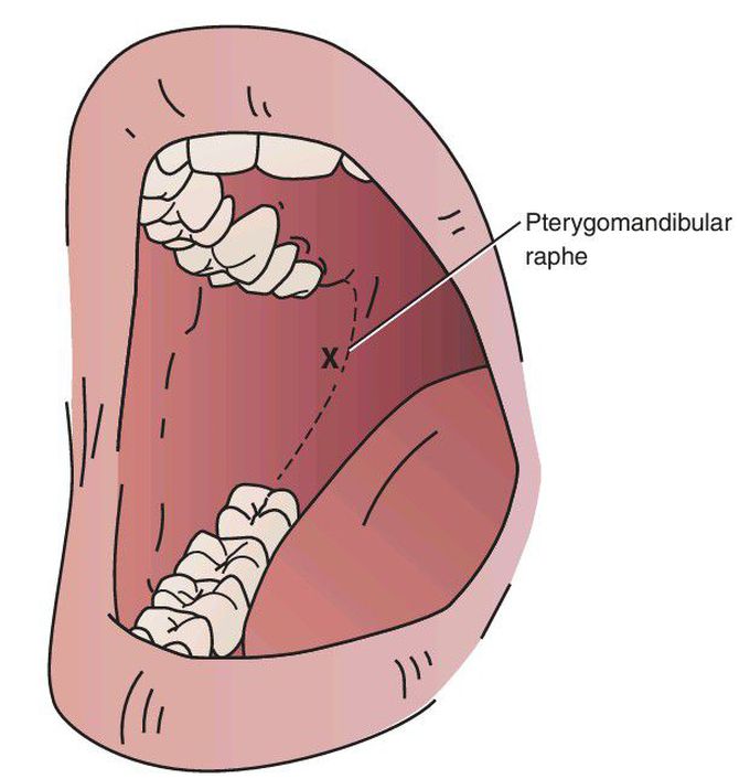 Inferior alveolar nerve block