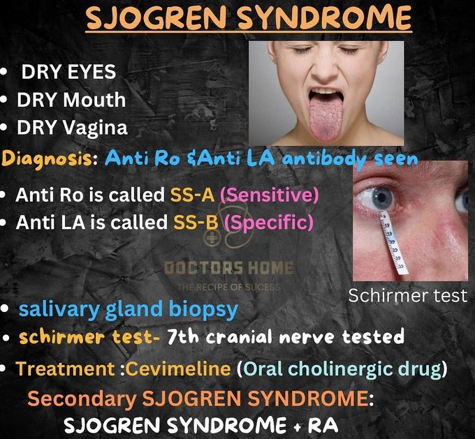 Sjogren Syndrome I