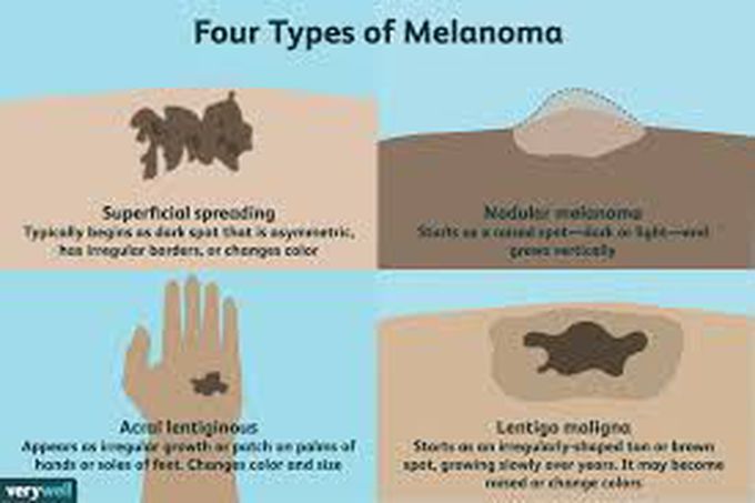 Treatment for melanoma