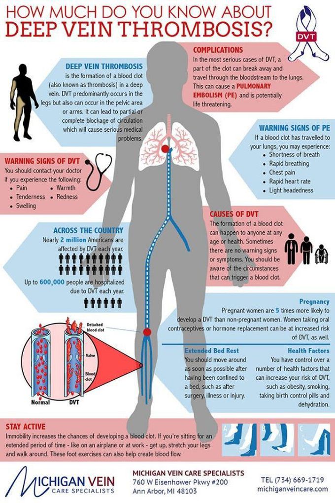 About DVT - MEDizzy