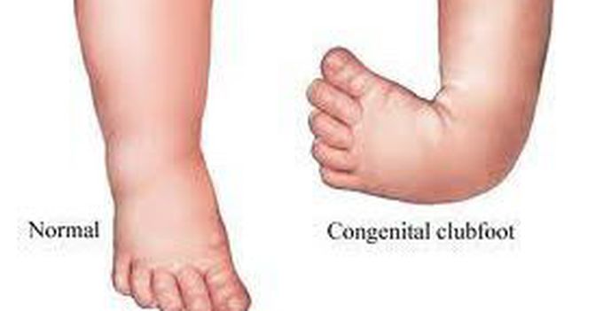 CONGENITAL TALLIPO EQUINOVARUS