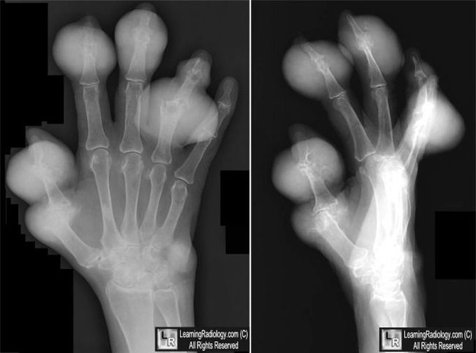 Tophaceous Deposits in Gout