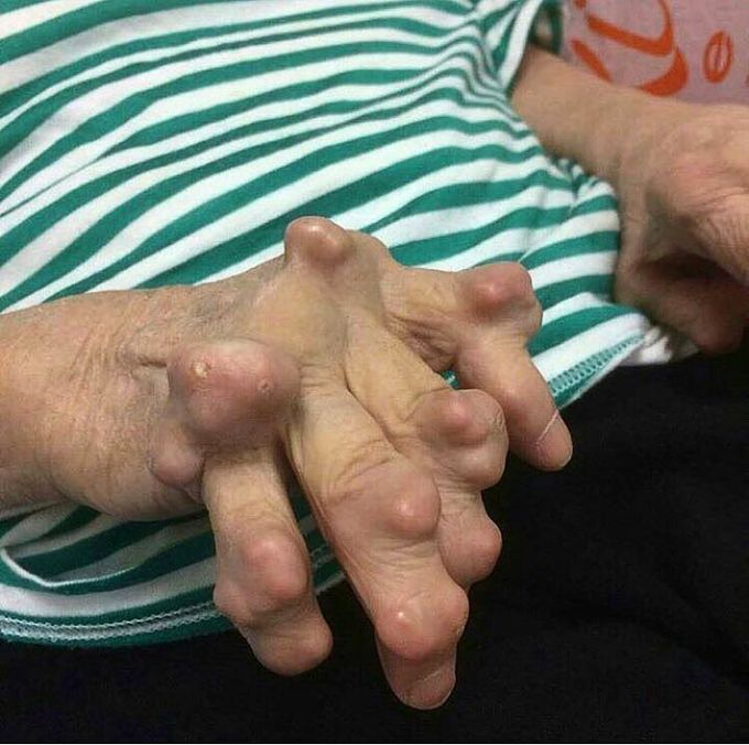 This is a case of exacerbated gout!!! 