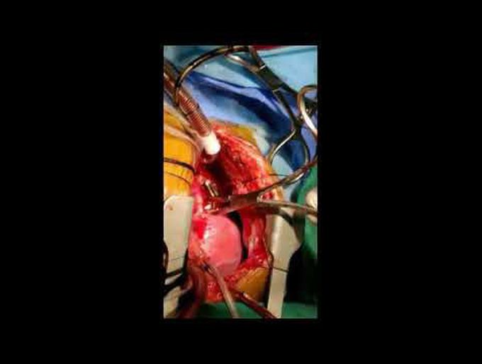 Anatomical Correction of Obstructed Mixed TAPVC