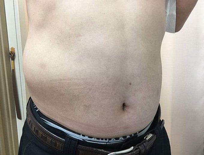 Aman aged 57 years had a tingling ache in his right lower back. An abdominal wall protrusion was observed on his right side, especially while he was standing. What pathogen is likely to be related in this clinical condition❓
A▪️Poliovirus

B▪️Cytomegalovirus

C▪️Varicella zoster virus

D▪️Rabies virus