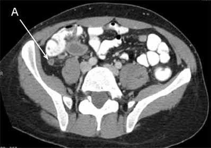 Case of Acute Appendicitis