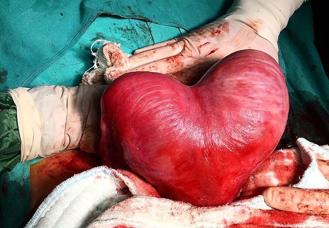 A heart shaped uterus ♥️ - well, it’s pathological!  