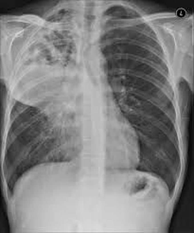 Lung abscess