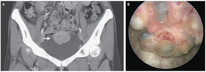 Bladder Endometriosis