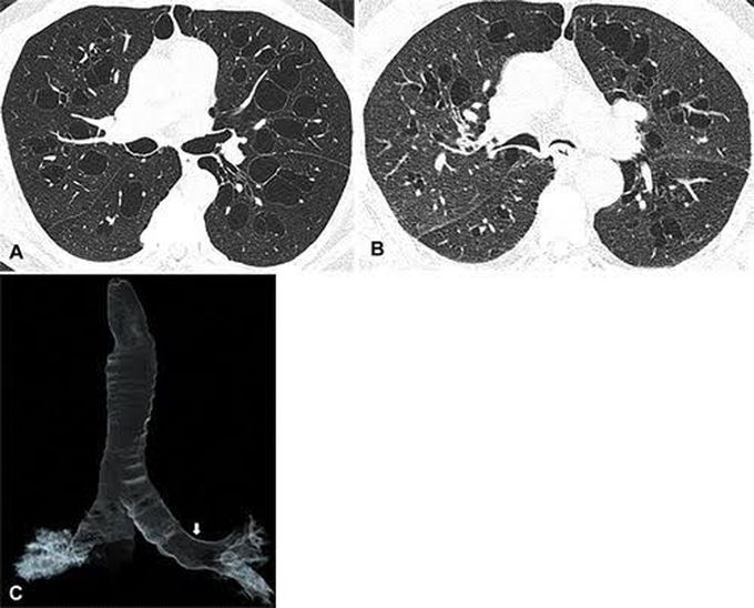 Symptoms of william campbell syndrome