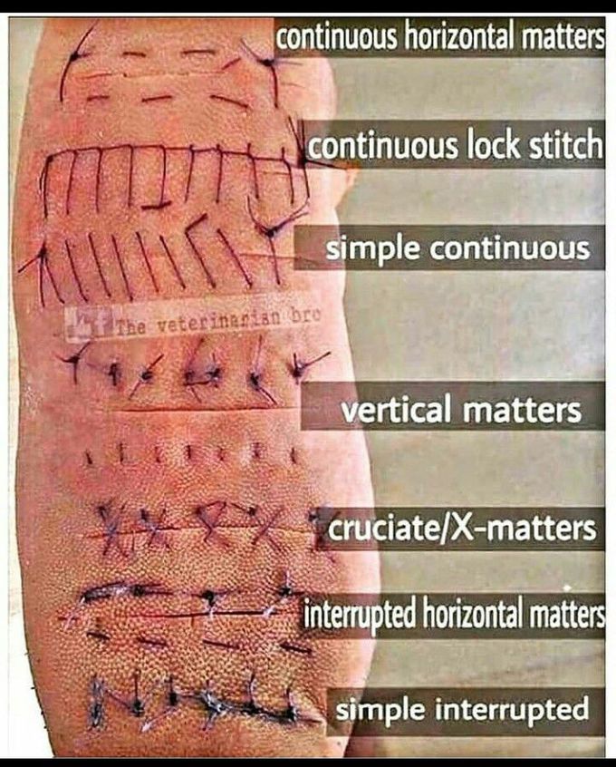 Types of Sutures