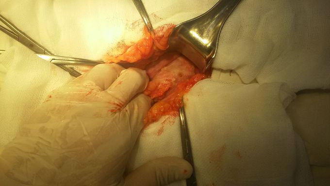 Perforation of duadenum