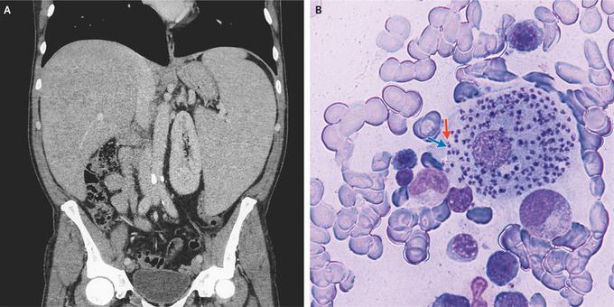 Visceral Leishmaniasis