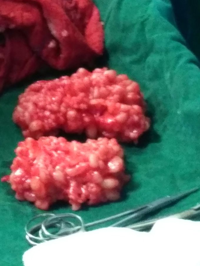 Diffuse multilobulated lipomatosis