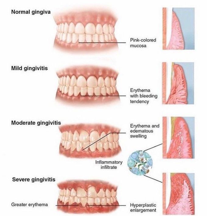 Gingivitis types