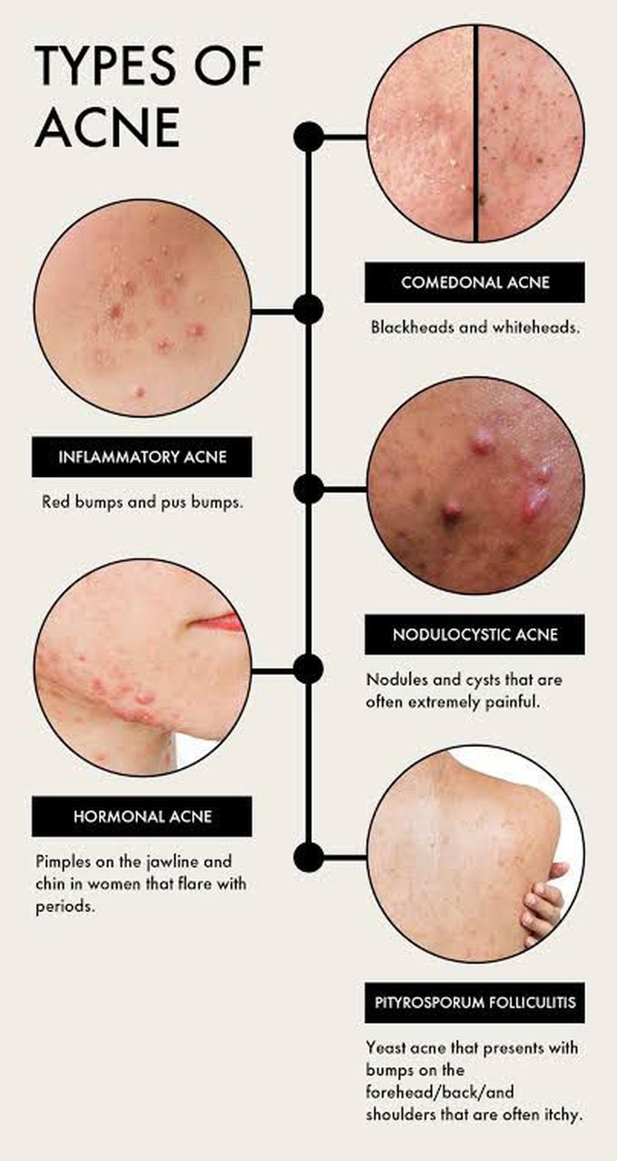 Types of Acne