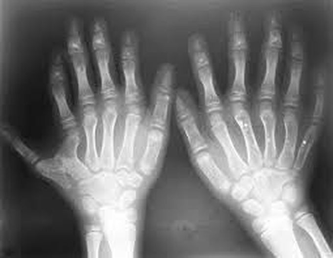 Polydactyly