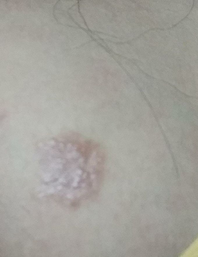 pinkish skin rash ..need diagnosis and treatment