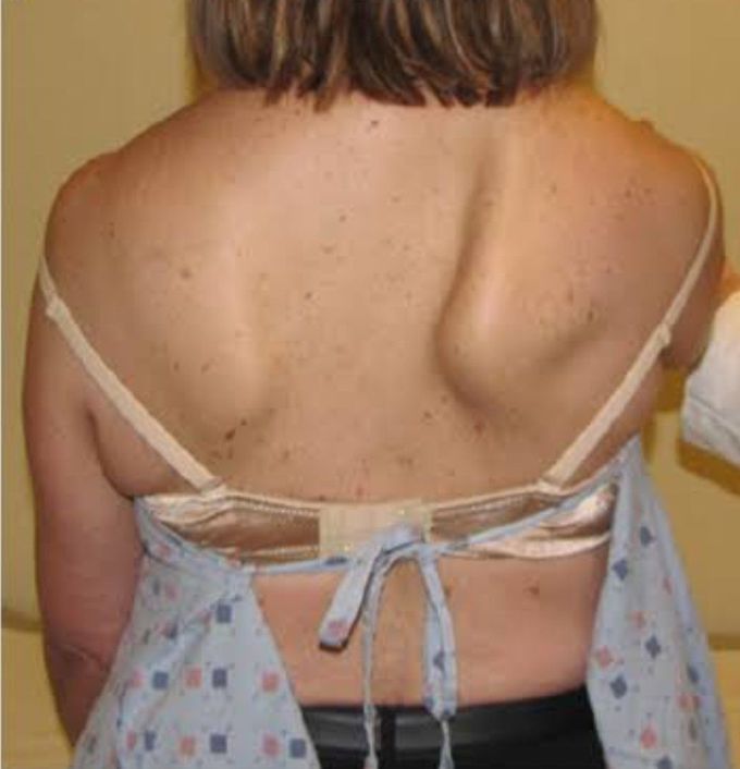 Winged scapula