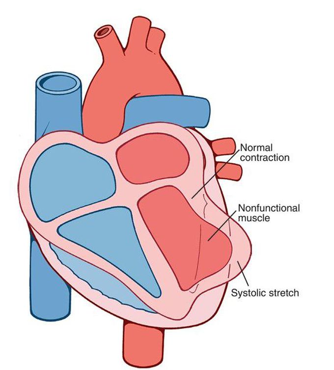 Systolic stretch