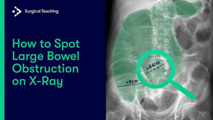 Large Bowel Obstruction | How do we  Diagnose it on Abdominal X-Ray?