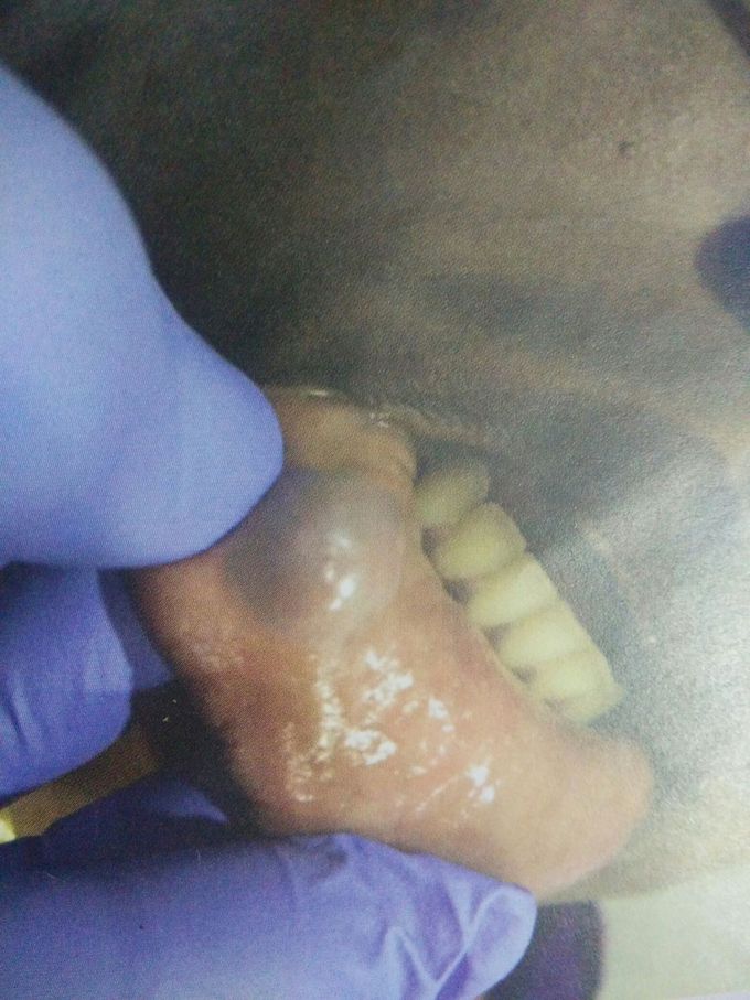 Mucocele (mucous extravasation cyst)