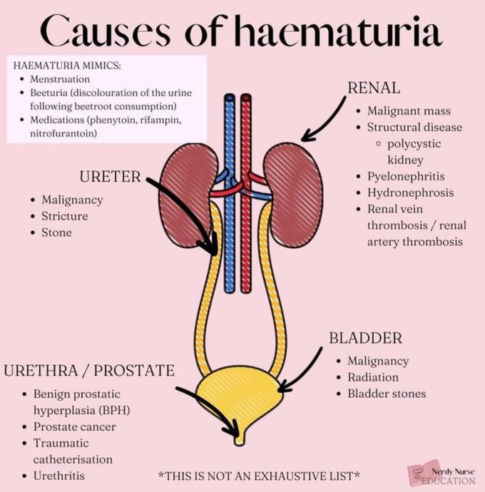 Causes of Hematuria