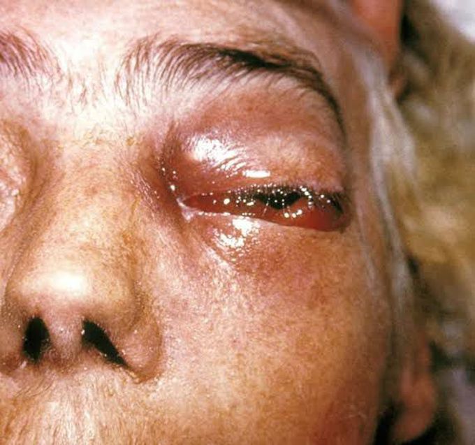 Mucormycosis