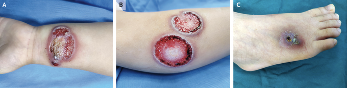 Pyoderma Gangrenosum