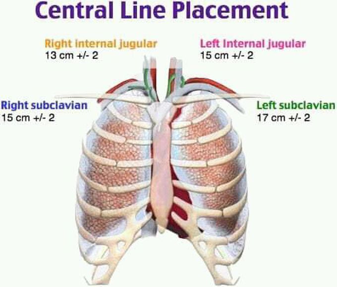 Cardiac ,mid line placement