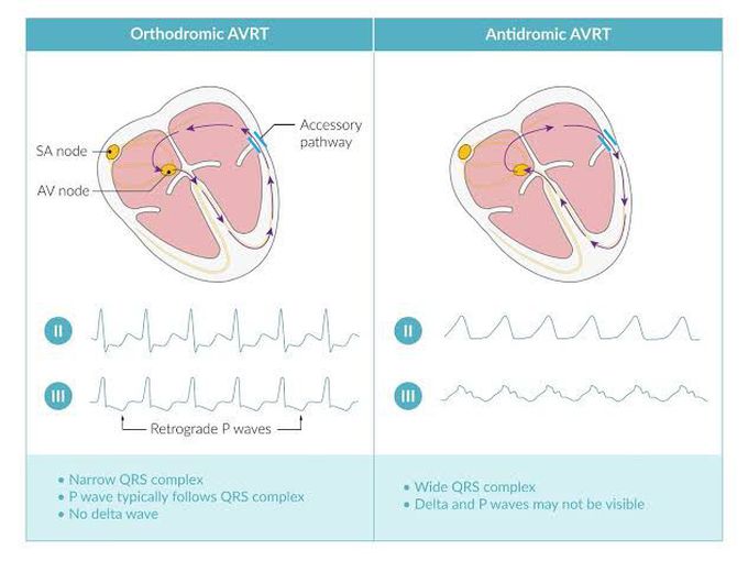 Orthodromic AVRT and Antidromic AVRT