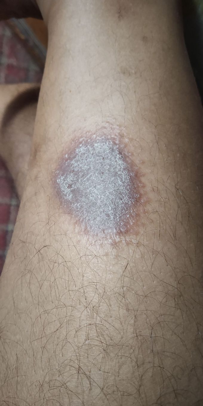 Psoriasis?