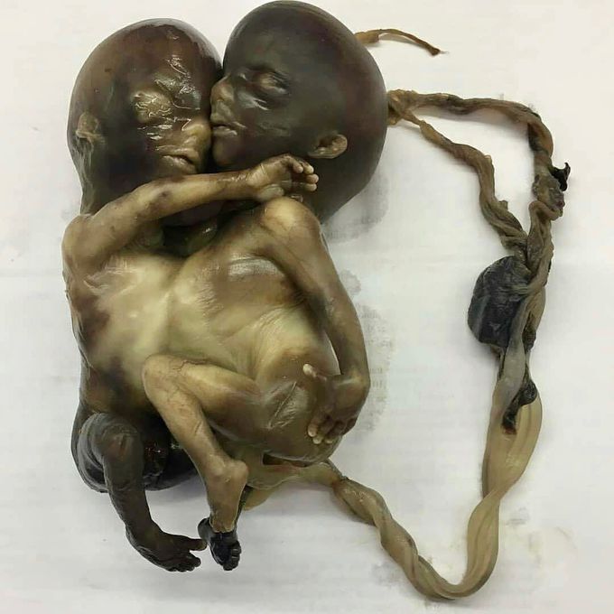 These are conjoined twins who shared the same heart. 
