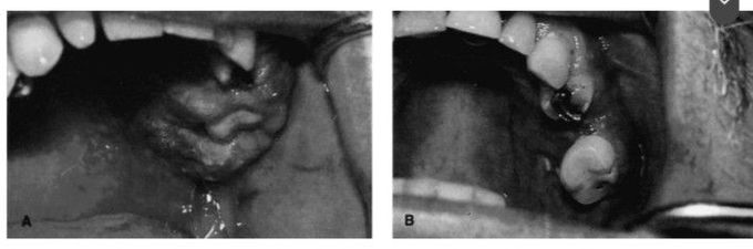 Case study of kaposi sarcoma