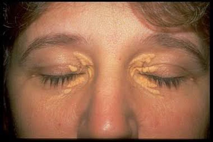 Xanthelasma