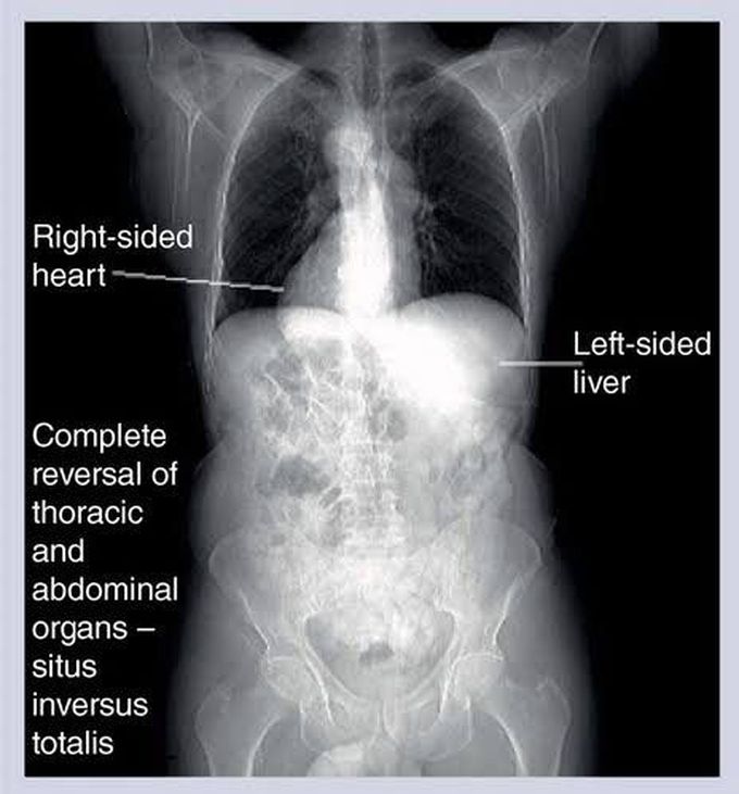 Situs inversus