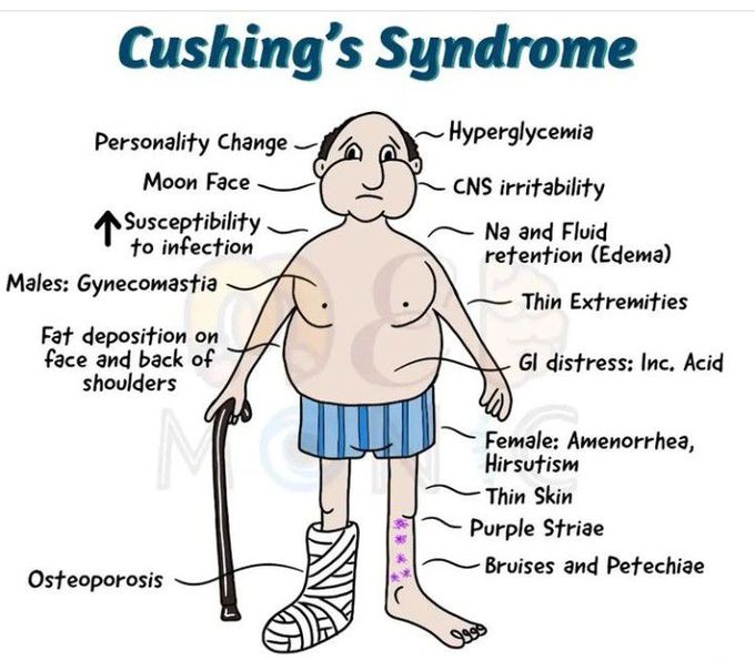 Cushing syndrome