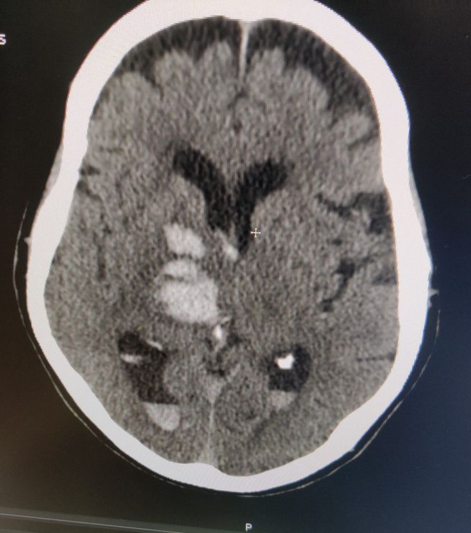 Hemorrhagic CVA