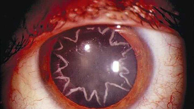 Star shaped cataract developed after an electrical shock!