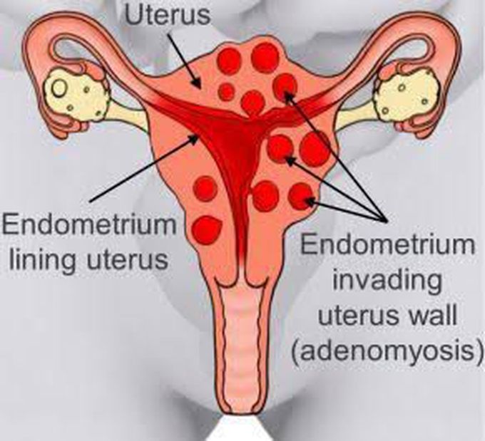 Causes Of Adenomyosis MEDizzy