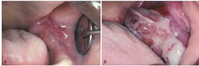 Metastatic Adenocarcinoma of the Colon