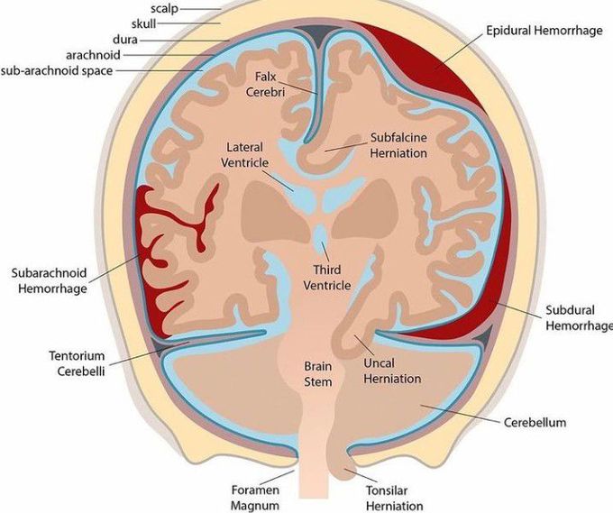 Hemorrhages