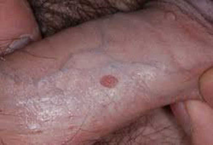 Symptoms of genital warts