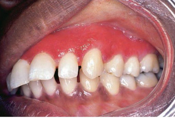 Discoid lupus erythmatosus of gingiva