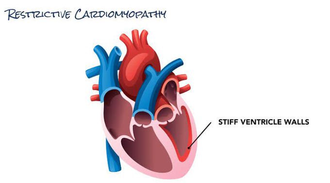 Restrictive Cardiomyopathy