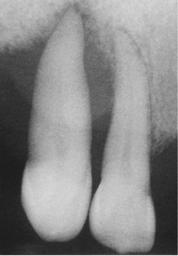 Periodontal Abscess.