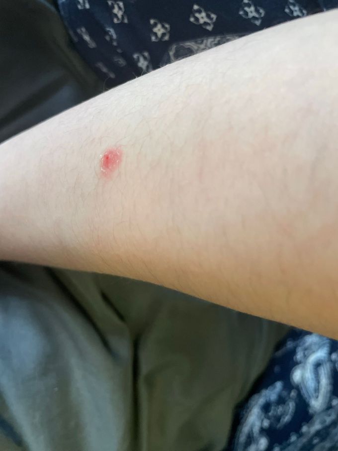 Random red spot on arm