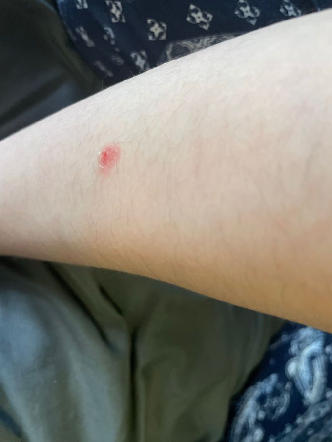 Why Did A Random Red Spot Appear On My Arm